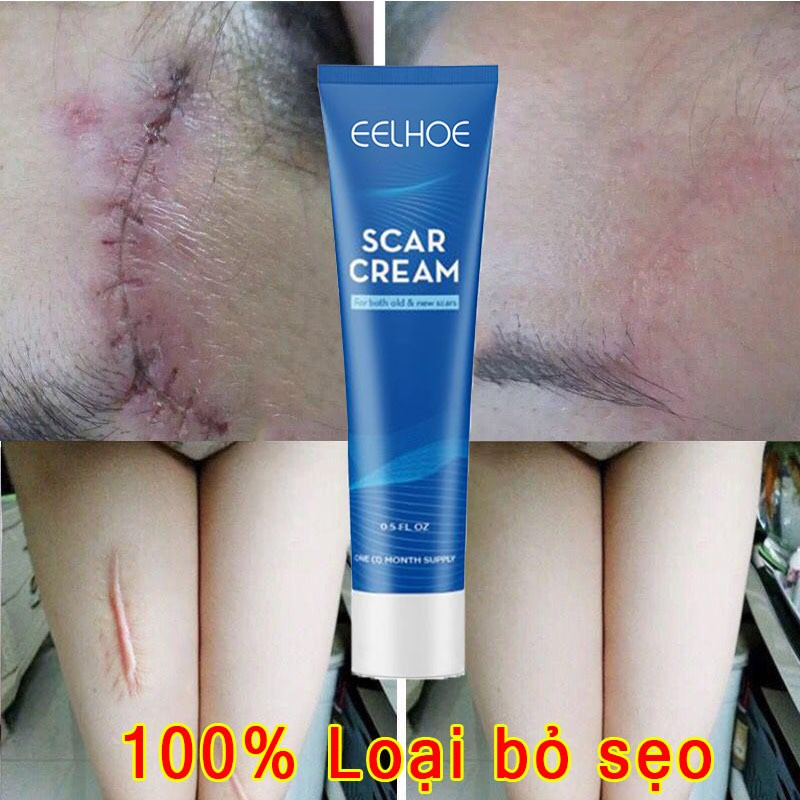 Kem xóa sẹo Kem sẹo Scar Care sẹo do bị thương sẹo bỏng sẹo phẫu thuật sửa chữa tất cả