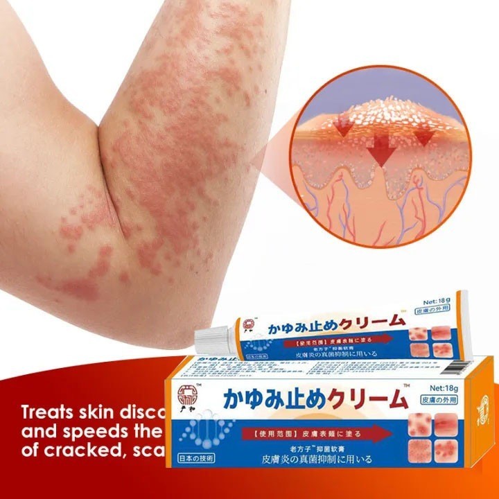 Kem Nhật Bản Bôi Nấm Kem Bôi Hắc Lào Thảo Dược, Phát Ban Tổ Đĩa Vảy Nến, Mề Đay Chính Hãng