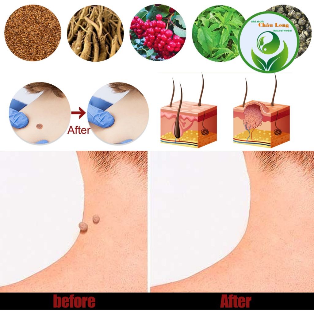 Kem South Moon Bôi Ngứa Vùng Sinh Dục, Mụn Sinh Dục, Sùi Mào Gà nam nữ, thành phần thảo dược Herbal Cream
