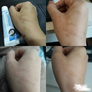 Kem làm mờ sẹo, thâm mắt rạn da Klirvin Nga