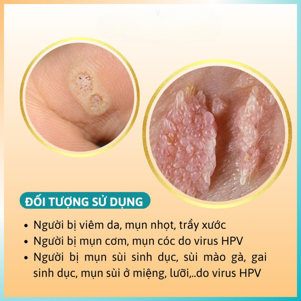Kem bôi sùi mào gà, mụn cóc HUPAVIR Ointment - Hỗ trợ phòng mọc lại, mụn cóc, sùi mào gà, mụn cơm