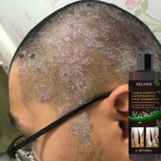 Gatal Kepala Bệnh vẩy nến Da đầu Ngứa Da đầu Dầu gội chống nấm Điều trị da đầu Chống gàu ❈ ❈ ❈ ❈ ❈ ❈ 🇾