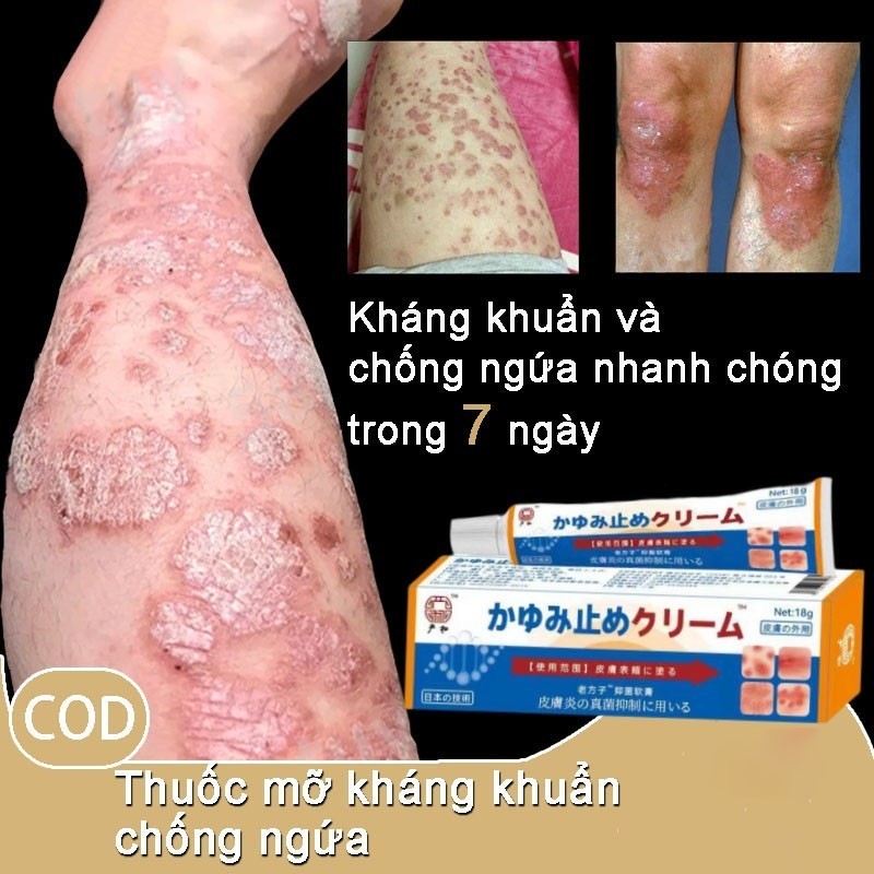 Kem Nhật Bản Bôi Nấm Kem Bôi Hắc Lào Thảo Dược, Phát Ban Tổ Đĩa Vảy Nến, Mề Đay Chính Hãng