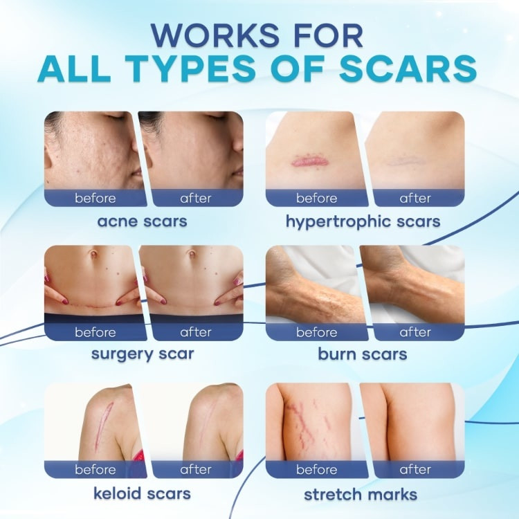 Kem xóa sẹo Kem sẹo Scar Care sẹo do bị thương sẹo bỏng sẹo phẫu thuật sửa chữa tất cả