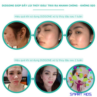 Dung dịch kháng khuẩn DIZIGONE