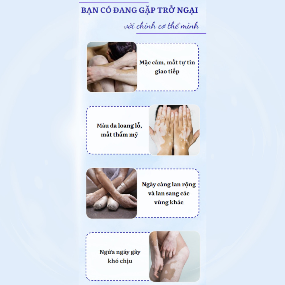 Tinh chất bôi lang ben, bạch biến OUHOE - Serum OUHOE bôi lang ben, bạch biến giúp đều màu da cho làn da trắng sáng 30ml