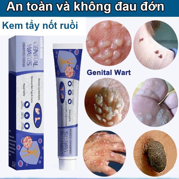 kem tẩy nốt ruồi trị mụn cóc kem mụn cóc 7 ngày loại bỏ mụn cóc nhanh chóng Loại bỏ mụn cóc an toàn 