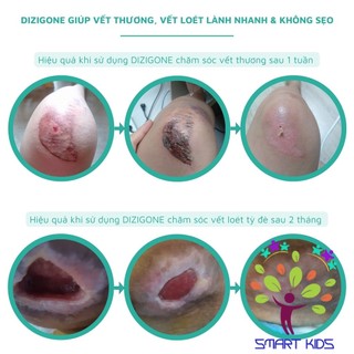 Dung dịch kháng khuẩn DIZIGONE