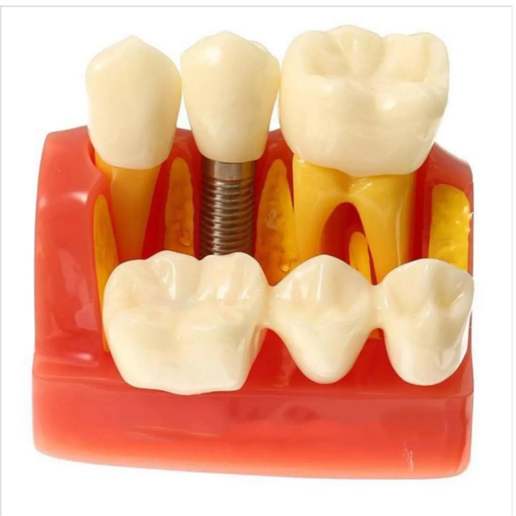 Mô hình răng miệng tham vấn implant,mẫu đối chiếu làm cầu răng và implant [ Smile Dental ]