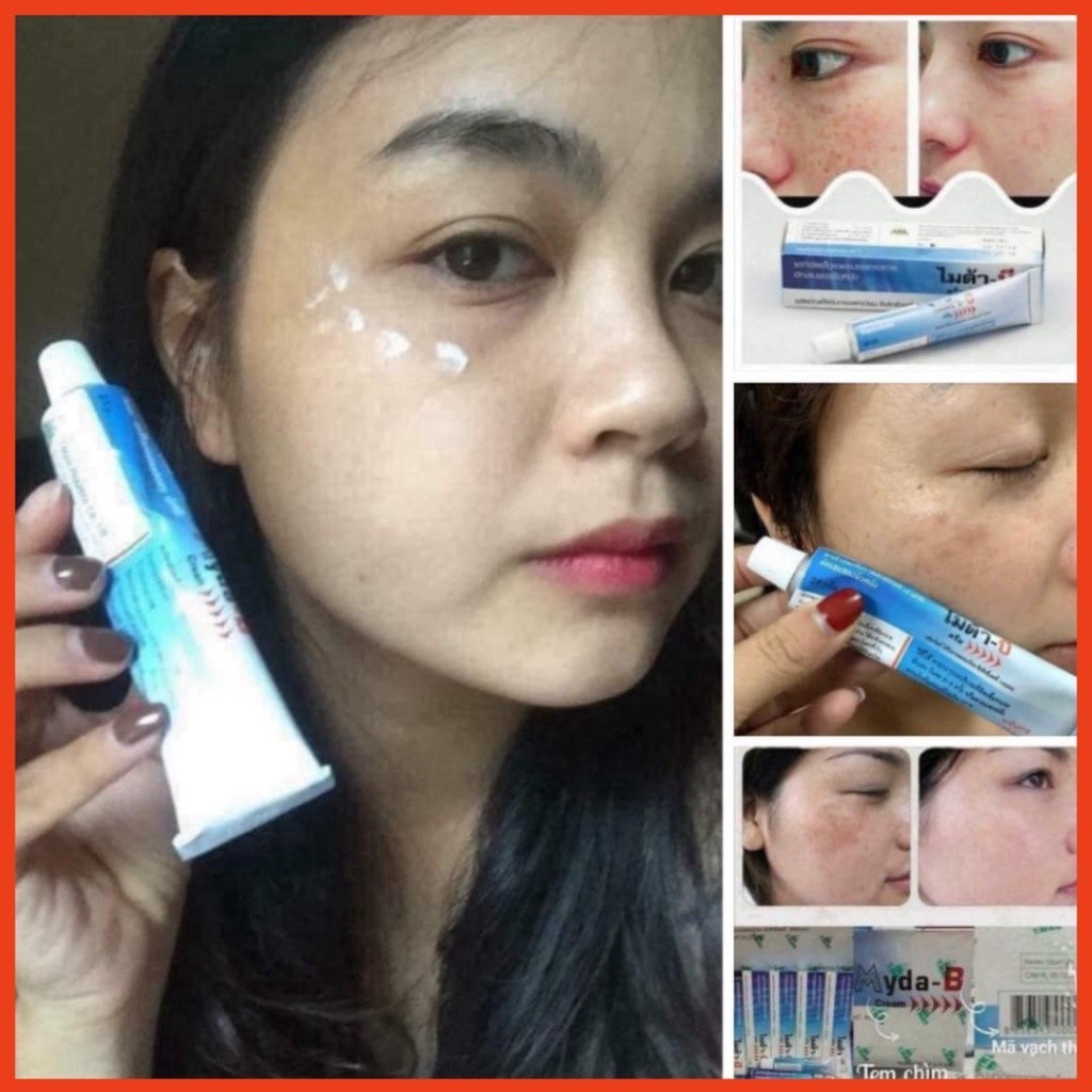 Kem nám tàn nhang MYDA-B Cream 25g - Kem nám Thái Lan MYDA-B mờ nám tàn nhang, đồi mồi, giúp dưỡng trắng da