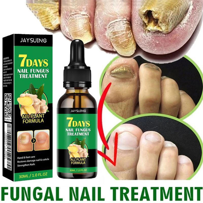 Tratamiento para Hongos en las Uñas - Suaviza las Uñas Gruesas, Blanquea las Uñas Descoloridas, Trat
