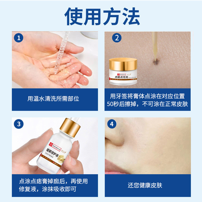 Kem Loại Bỏ Nốt Ruồi Nam Kinh Tongrentang Vàng Xanh Nhà Euro Loại Bỏ Nốt Ruồi Lụa Euro Thịt Hạt Mỡ E