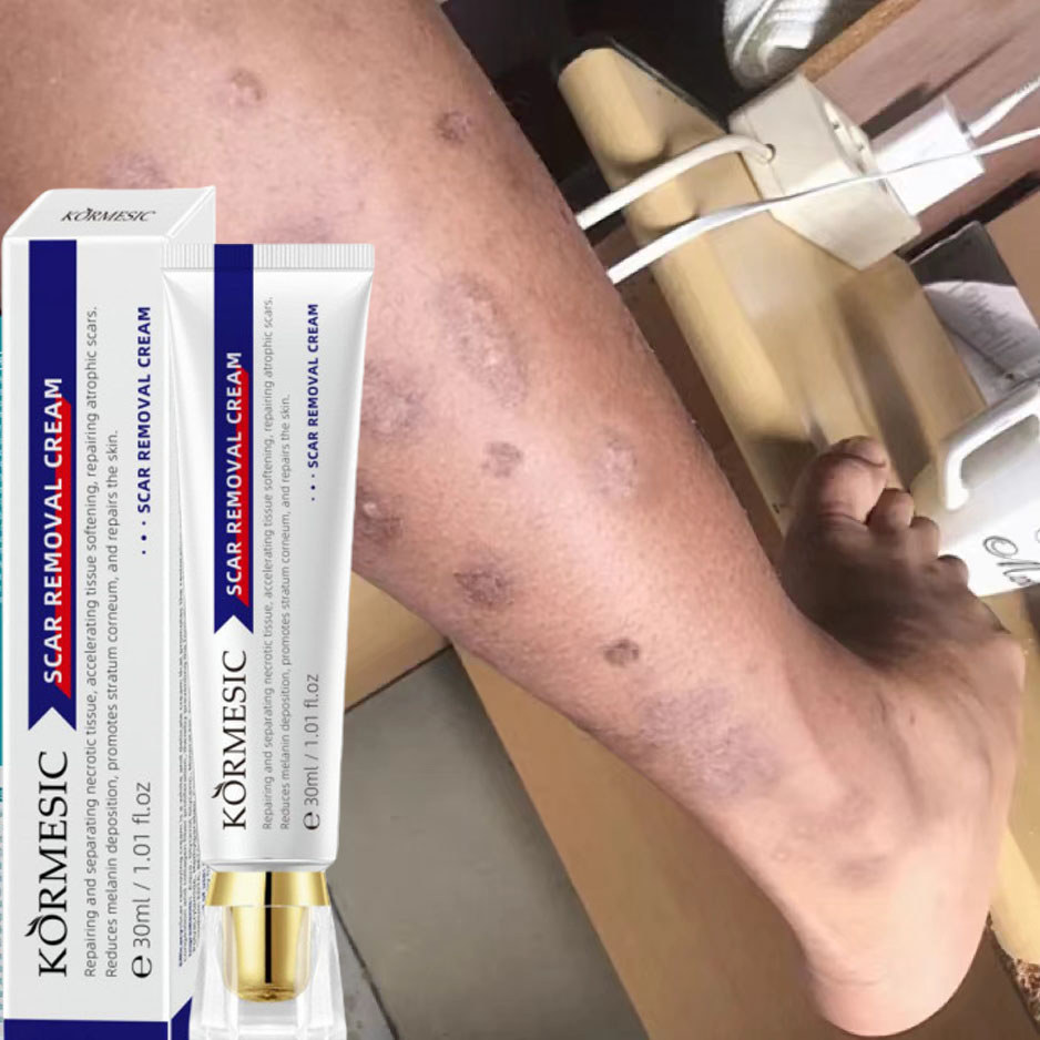 Kem XóA SẹO ThâM SẹO PhẫU ThuậT LồI LõM Rỗ Mờ ThâM MụN RạN Da NgừA MụN Kem Mờ SẹO LâU NăM Kem LàM Mờ SẹO ThâM