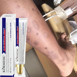 Kem XóA SẹO ThâM SẹO PhẫU ThuậT LồI LõM Rỗ Mờ ThâM MụN RạN Da NgừA MụN Kem Mờ SẹO LâU NăM Kem LàM Mờ SẹO ThâM