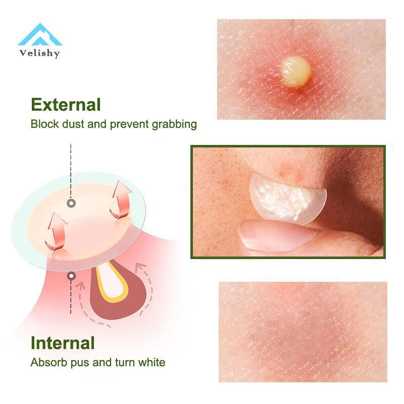 Velishy 1 / 5 Cái Miếng Dán Mụn Vô Hình Hydrocoloid Che Khuyết Điểm Mụn Miếng Dán Ánh Sáng Thoáng Kh