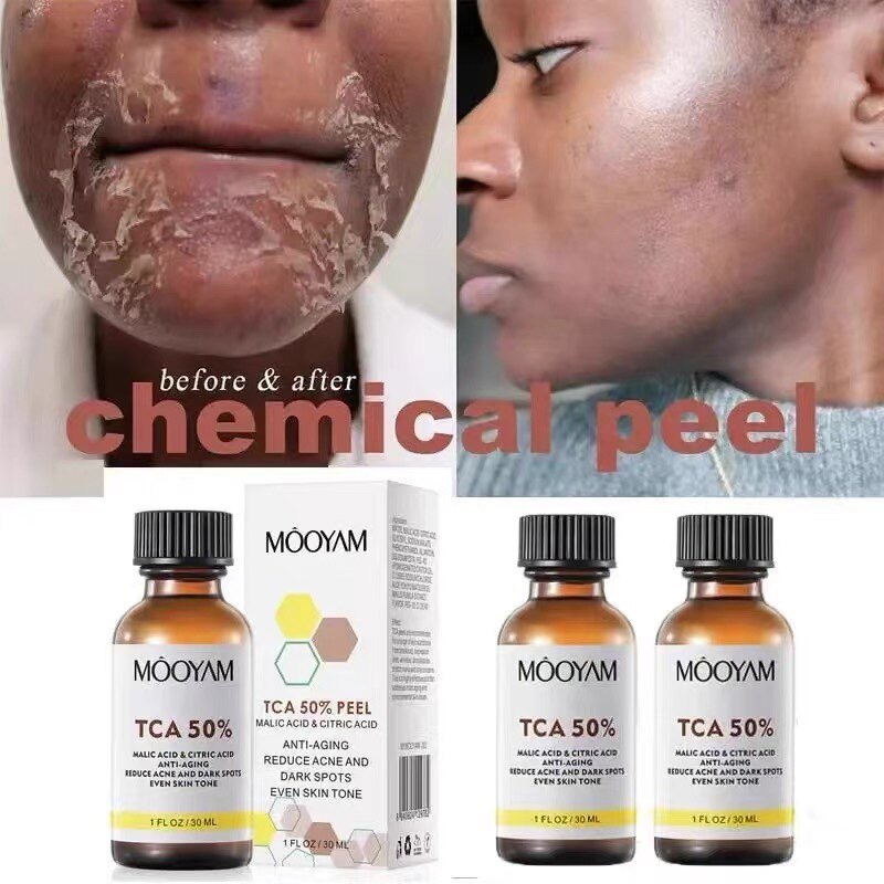 TCA 50% Hóa Chất Peel Tca Peel Acid Skin Superforce Peel