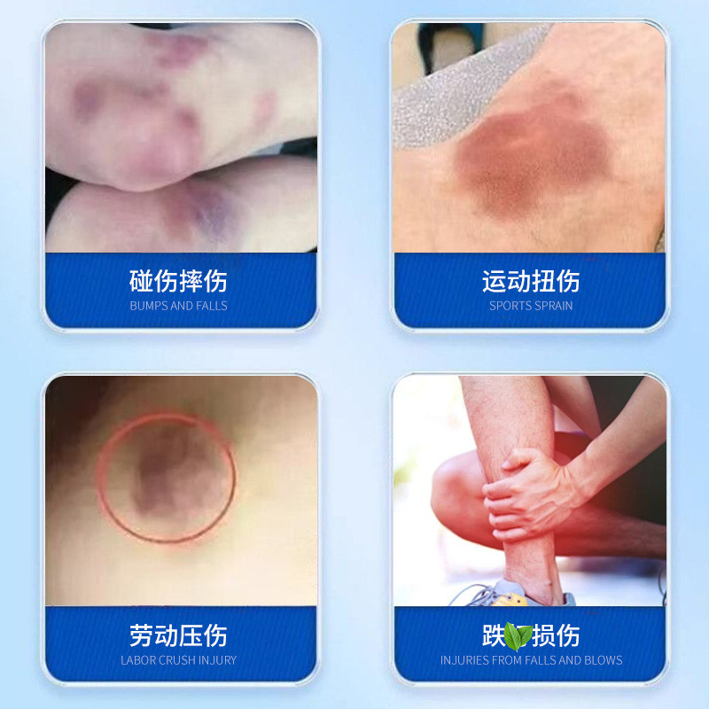 Hàng sẵn có Vận chuyển nhanh Bruises Sử dụng bên ngoài Kem tổn thương Bruises Bruises Tập thể dục bo