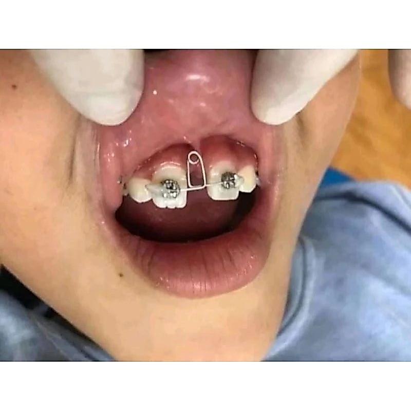 Combo Loop đóng khoảng răng cửa + 2 cái mắc cài niềng răng