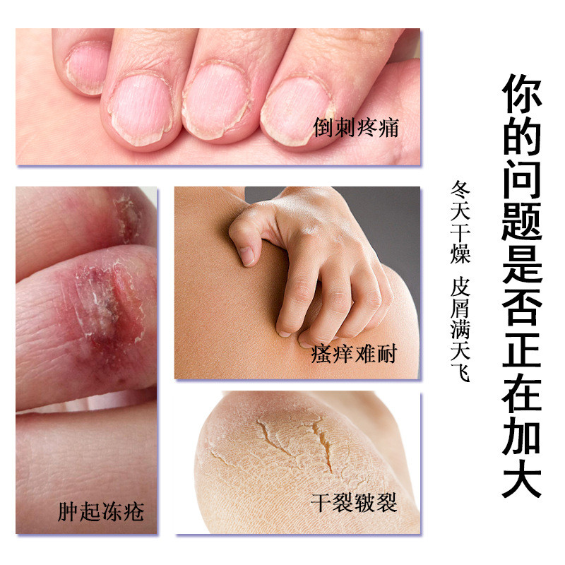 Safflower Dầu Rắn Frozen Sore Frozen Kem Chăm Sóc Sức Khỏe 0g Tai Tay Da Mặt Frozen Sore Cracked Fro