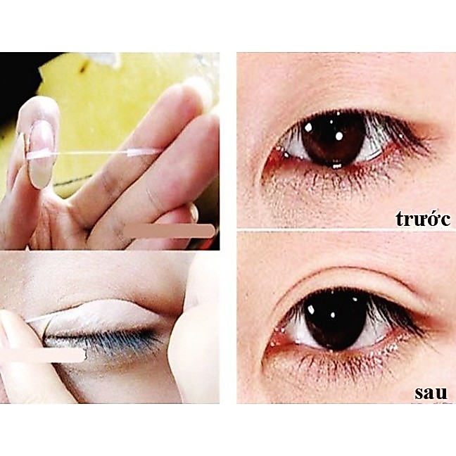 Chỉ tạo mắt 2 mí siêu tự nhiên