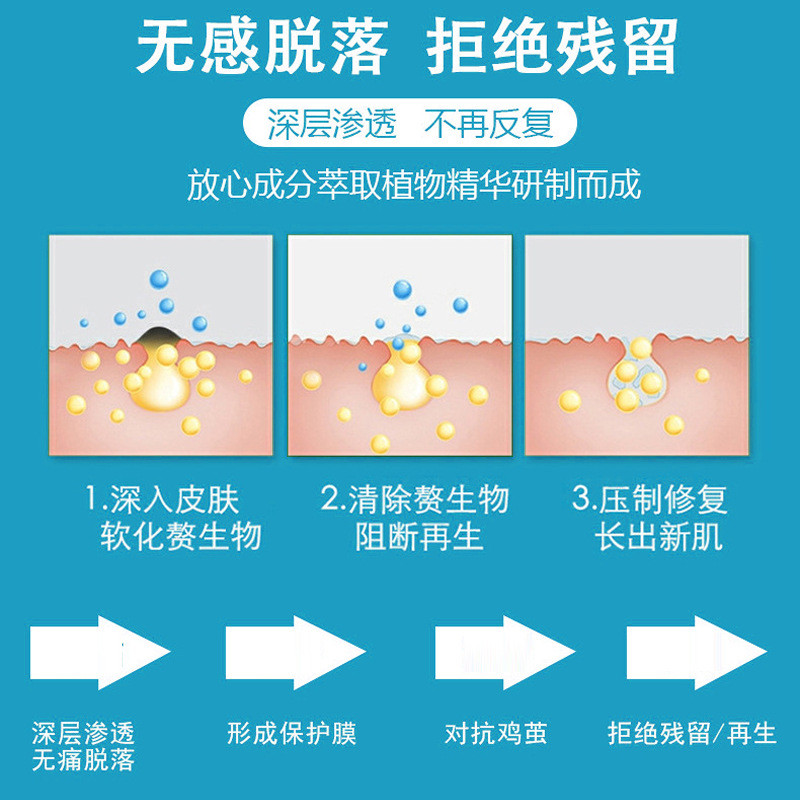 Cocoons gà Kangyunan Materia Medica Loại bỏ không đau Ngô Calluses Ngón chân Eugene Flat Eugene Palm