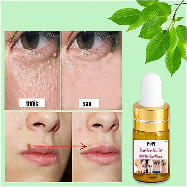 Kem Xóa Nốt Ruồi Mụn Thịt Tàn Nhang