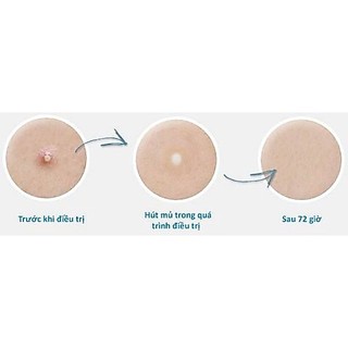 Miếng dán mụn Mayan Care