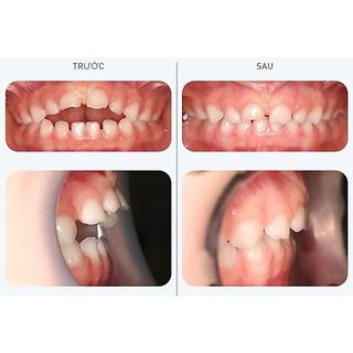 [Y Tế Bạch Mai] Dụng Cụ Niềng Răng Trainer T4K Hàng ÚC