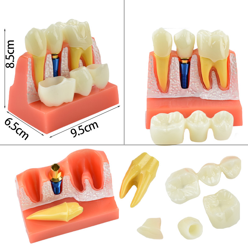 Mô hình răng nha khoa Phân tích cấy ghép nha khoa Cầu vương miện nha khoa Mô hình có thể tháo rời Mô hình giảng dạy và đào tạo
