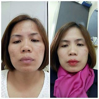 COMBO HỖ TRỢ LÀM GIẢM MỤN LAVOINE