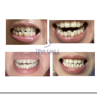 Khay niềng răng trong suốt True Smile (cần mẫu hàm răng )