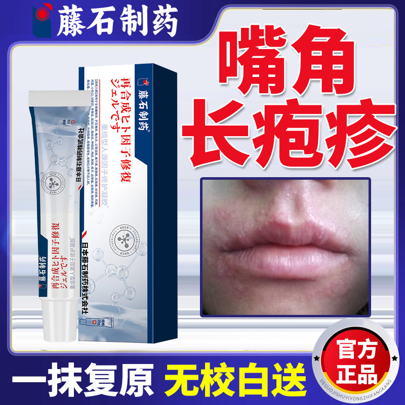 Góc Herpes Dài Herpes Miệng Môi Nước Tạo Bọt Đau Nóng Kích Thích Đau Lửa Tạo Bọt Miệng Xấu Herpes Ke