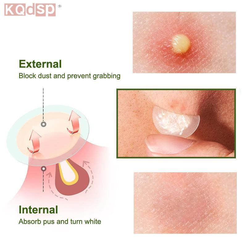 KQdsp 1 / 5 Cái Miếng Dán Mụn Vô Hình Hydrocoloid Che Khuyết Điểm Mụn Miếng Dán Ánh Sáng Thoáng Khí 