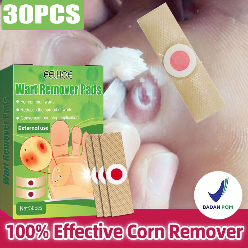 Miếng dán plasters (Hộp 30 miếng Plaster - Tem chống hàng giả) Xử lý Mụn cóc, Mắt cá chân, Vết chai,