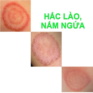 Kem bôi Hết Hẳn Nấm ngứa, Nấm hình tròn, Nấm đồng xu, Hắc lào Háng, Bụng, Đùi, Mông (Cực hiệu quả)_ loại 30g