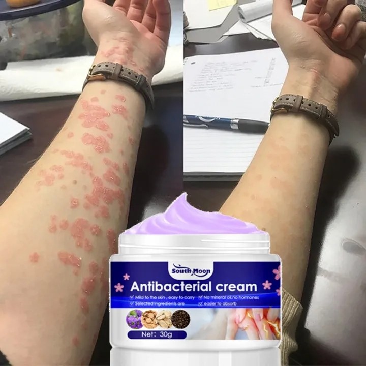 kem bôi nấm ngứa kem bôi ngoài da ghẻ ngứa Kem chống ngứa 30g kem bôi chàm Kem bôi vảy nến