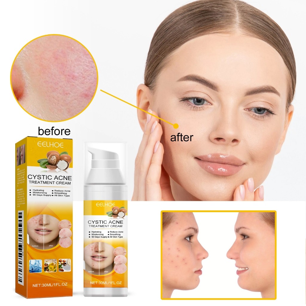 EELHOE Tinh chất dưỡng da mặt dành cho mụn, mụn ẩn, khuyết điểm, làm da mềm mại và sáng đẹp