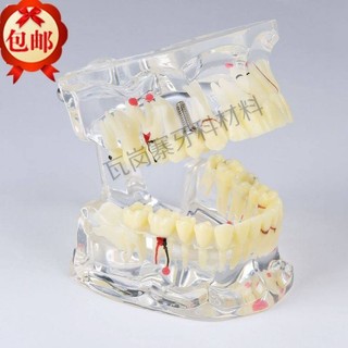 Có sẵn Xiaohongshu Đề xuất mô hình răng nha khoa Pha lê trong suốt Răng người lớn Mô hình bệnh lý toàn diện Kéo dài bệnh lý miễn phí