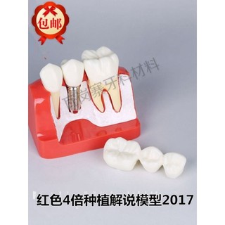 Có sẵn Xiaohongshu Đề Nghị Sửa Chữa Nha Khoa Mô Hình Trồng Sửa Chữa Cơ Thể Mô Hình Trồng Móng Tay Bóng Nắp Kết Hợp Phủ Răng Giả Mô Hình Miệng Miễn Phí Vận Chuyển