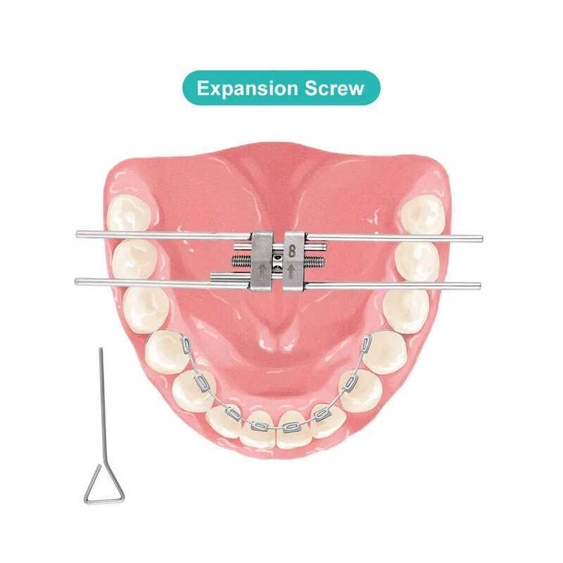 Vít mở rộng nha khoa Nhanh chóng Palatal Expander Hyrax Mini Tiêu chuẩn Khung thép không gỉ Nha khoa