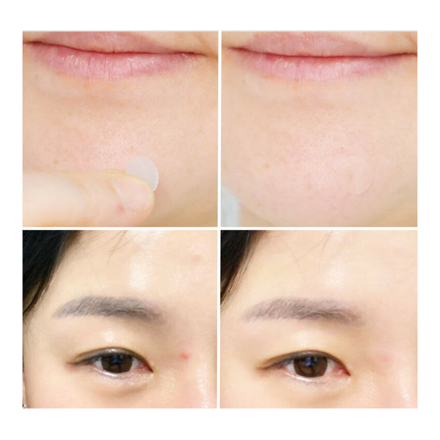 Miếng dán xẹp mụn tàng hình Dongkook Madeca