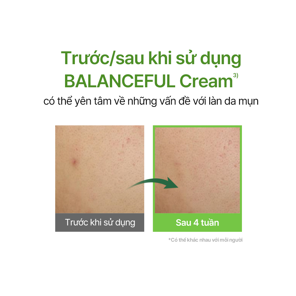 Serum TORRIDEN cân bằng hỗ trợ giảm mụn dưỡng da 50ml + 50ml