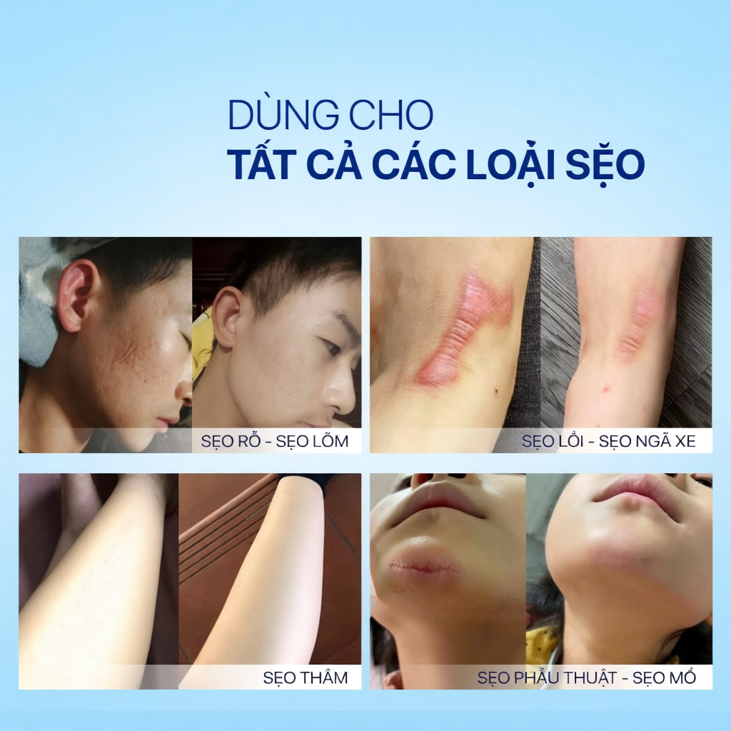 Combo Kem và Serum Hỗ trợ mờ sẹo lồi, lõm, rỗ, thâm mụn, Actiscar lâu năm nhanh chóng tại nhà