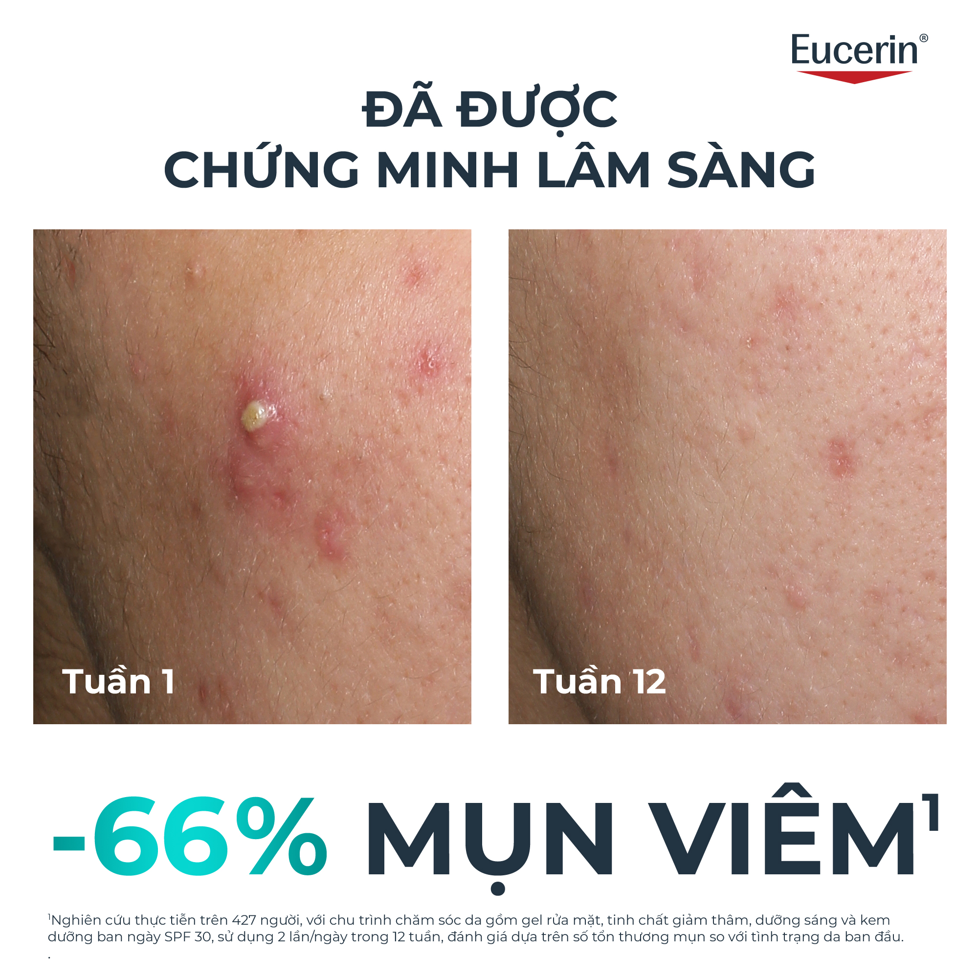 Tinh chất giúp giảm thâm mụn và dưỡng sáng da Eucerin® DermoPure Clinical Triple Action 40ml | BigBuy360 - bigbuy360.vn