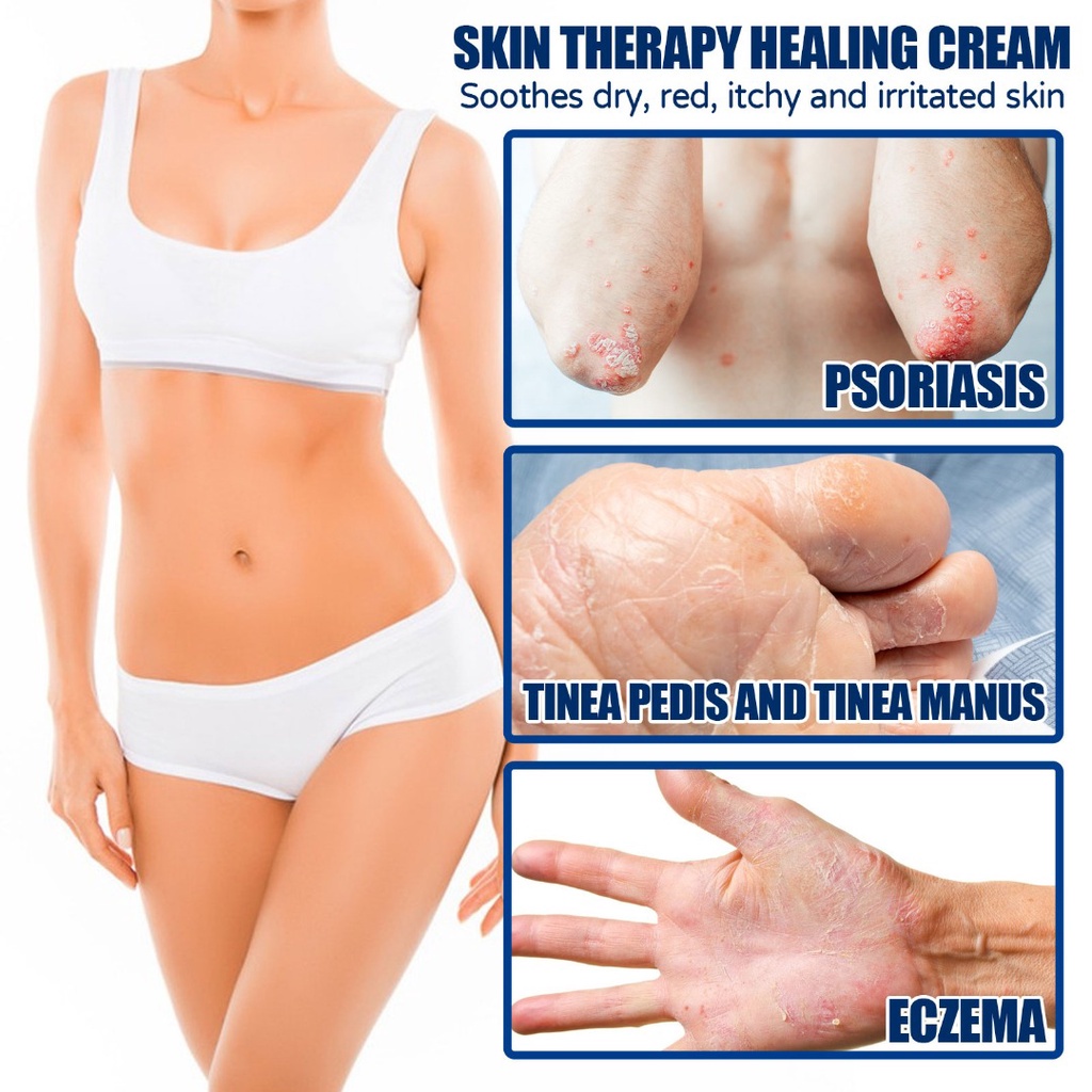 Kem Chăm Sóc Da Chống Ngứa Kháng Khuẩn Tiện Dụng