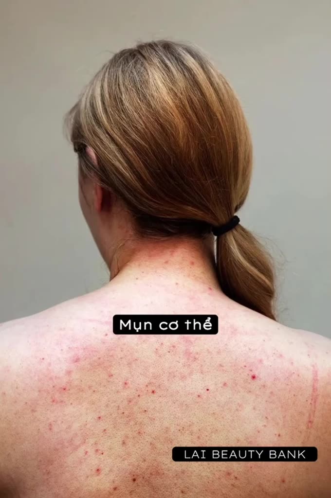 [ Công ty ] Kem dưỡng thể 2% BHA Body giảm mụn cơ thể, giảm dày sừng cổ nang lông hiệu quả | BigBuy360 - bigbuy360.vn