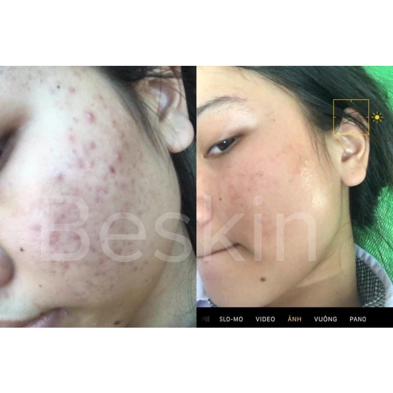 SERUM MỤN BESKIN