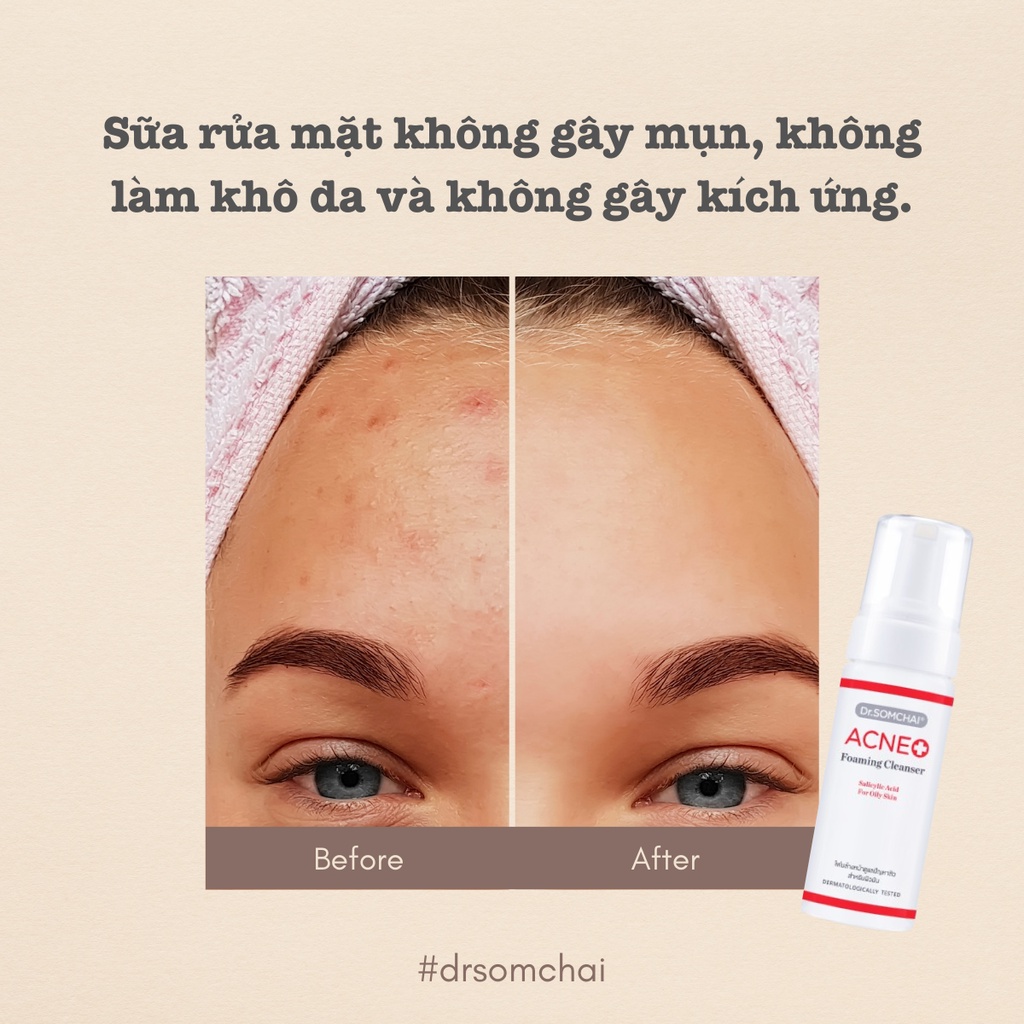 Bọt rửa mặt cho da mụn DR.SOMCHAI ACNE nhẹ nhàng tẩy tế bào chết và làm sạch da từ sâu bên trong giúp giảm mụn 150ml