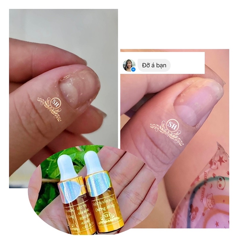 Serum Nấm Móng Tay Chân Khử Nấm Móng Hư Khóe Bọng Móng Nặng Nước Ăn Tay Chân gia Truyền