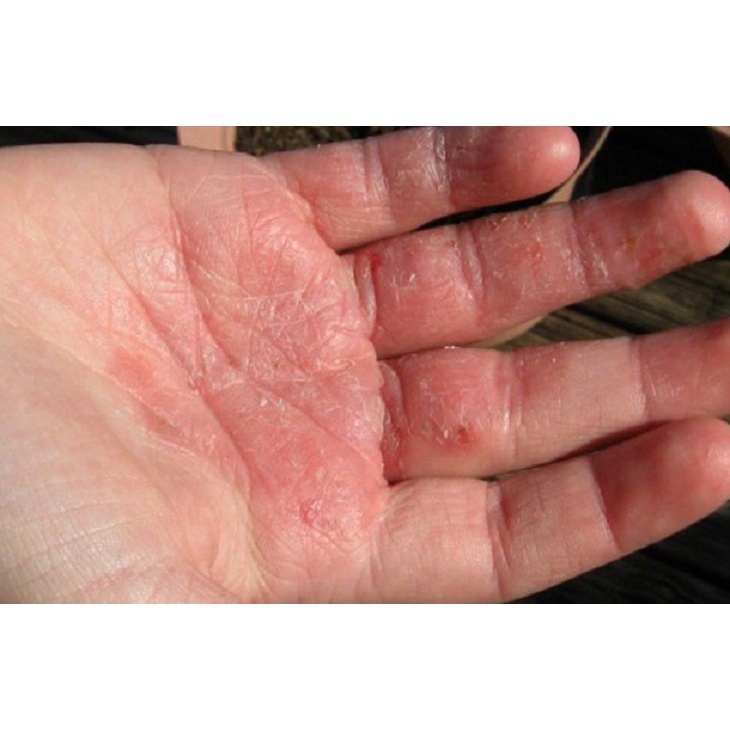 Thảo dược HẾT SẠCH bong da đầu ngón tay ngón chân, lòng bàn tay, bàn chân